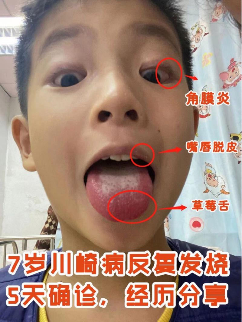 川崎病是什么病？川崎病的症状和治疗方法是什么？