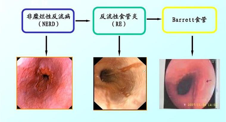 得了巴雷特食管严重吗？如何预防和治疗？