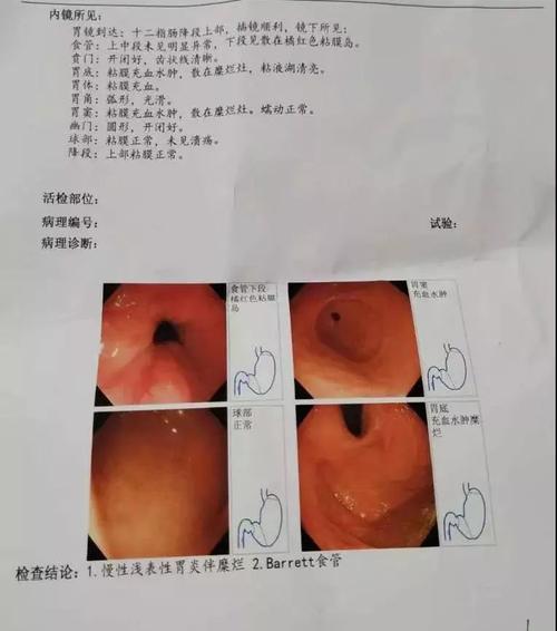 得了巴雷特食管严重吗？如何预防和治疗？