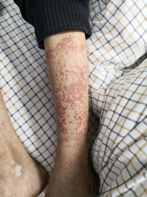 过敏性紫癜严重吗？皮肤症状与肾脏损害的严重程度对比