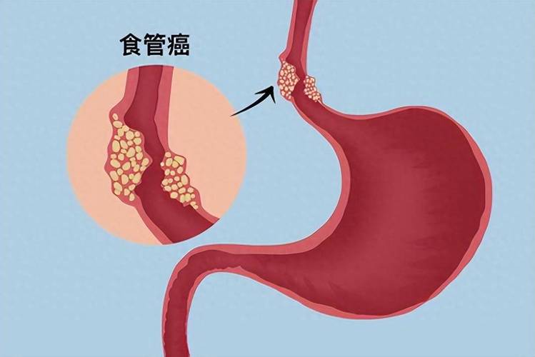得了巴雷特食管严重吗？如何预防和治疗？