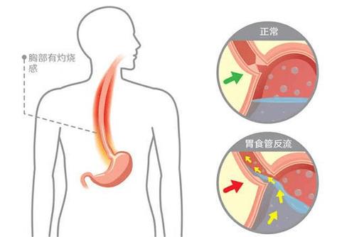 得了巴雷特食管严重吗？如何预防和治疗？