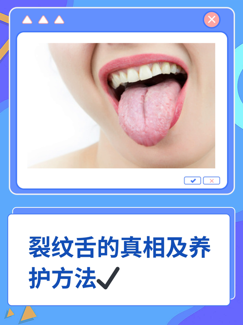 为什么我的舌头会有裂纹？中医和西医的解释及治疗方案