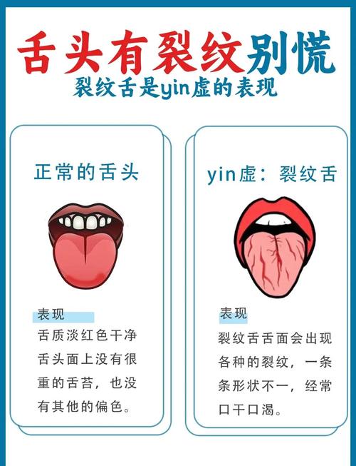 为什么我的舌头会有裂纹？中医和西医的解释及治疗方案