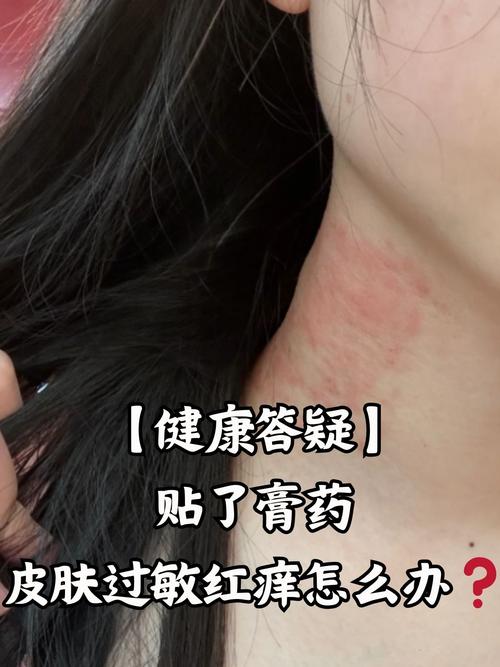 如何治愈过敏性皮炎？过敏性皮炎的治疗方法及预防