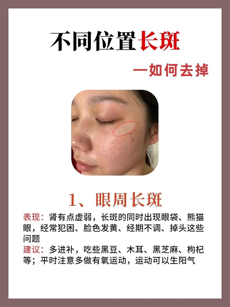 满脸雀斑去除方法有哪些？快速淡斑小技巧