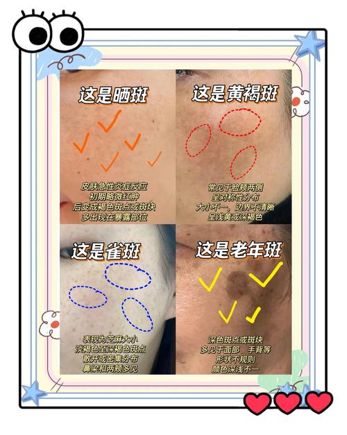 满脸雀斑去除方法有哪些？快速淡斑小技巧