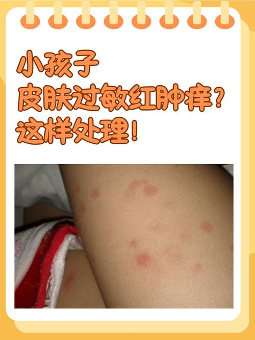 皮肤过敏红痒的急救处理方法，快速缓解你的不适