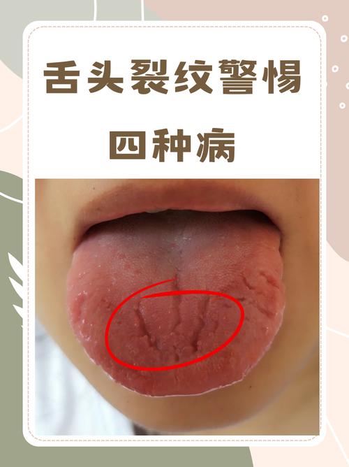 为什么我的舌头会有裂纹？中医和西医的解释及治疗方案