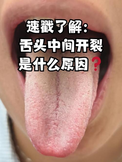 为什么我的舌头会有裂纹？中医和西医的解释及治疗方案