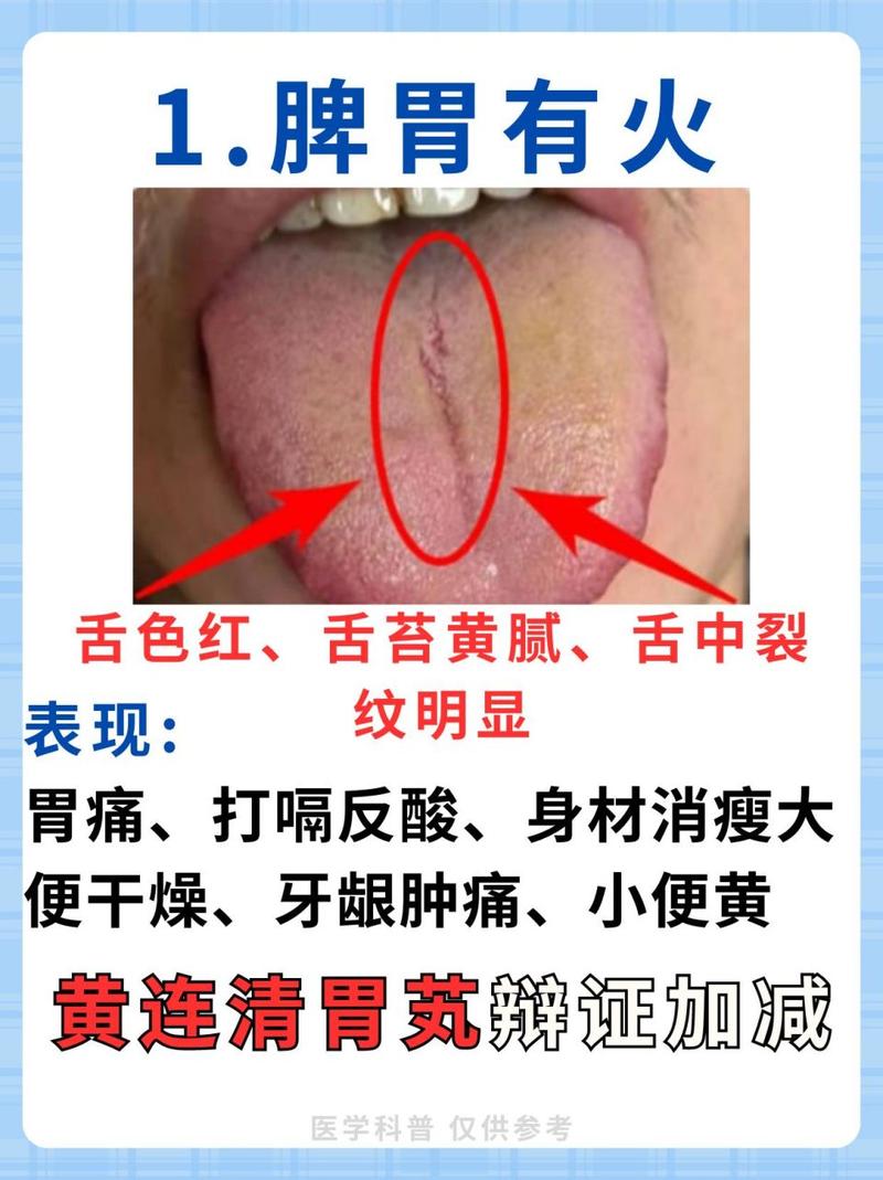 为什么我的舌头会有裂纹？中医和西医的解释及治疗方案
