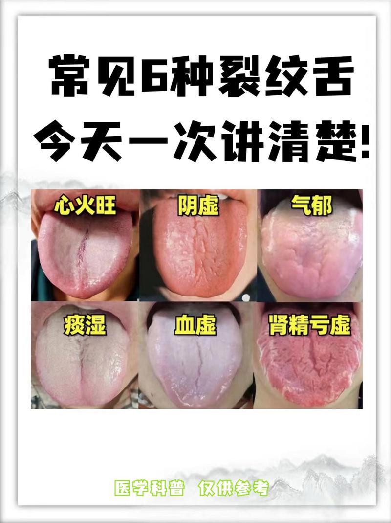 为什么我的舌头会有裂纹？中医和西医的解释及治疗方案