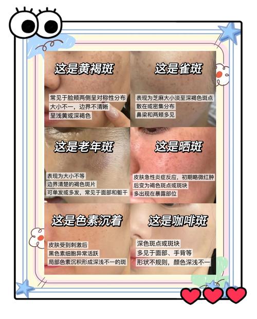 满脸雀斑去除方法有哪些？快速淡斑小技巧