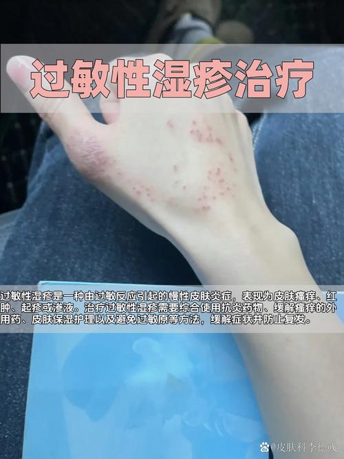 皮肤过敏红痒的急救处理方法，快速缓解你的不适