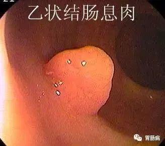 尤文氏肉瘤能治愈吗？治愈率高吗？