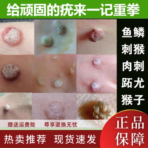 尤文氏肉瘤的治疗方法有哪些？会是绝症吗？