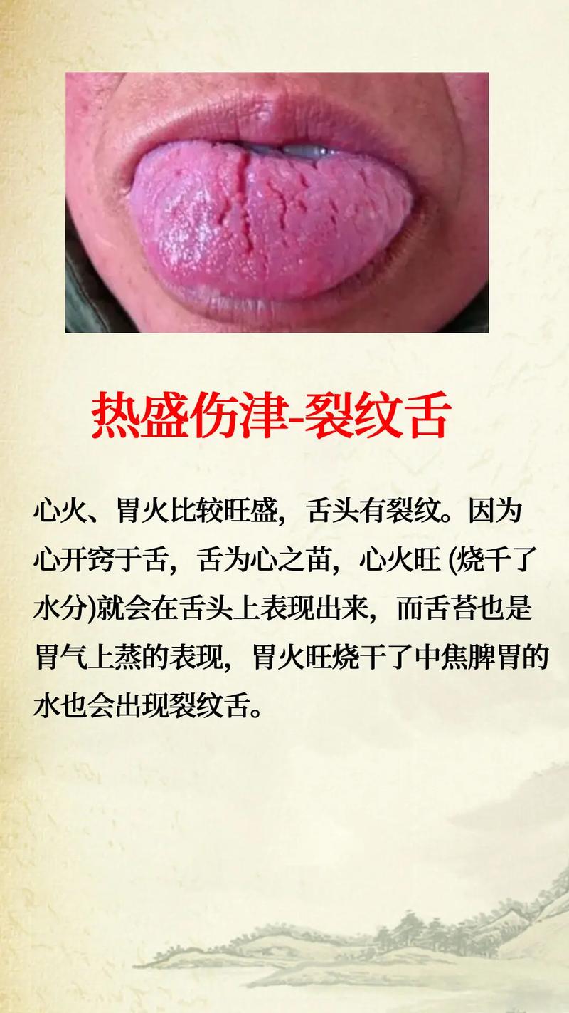 为什么我的舌头会有裂纹？中医和西医的解释及治疗方案