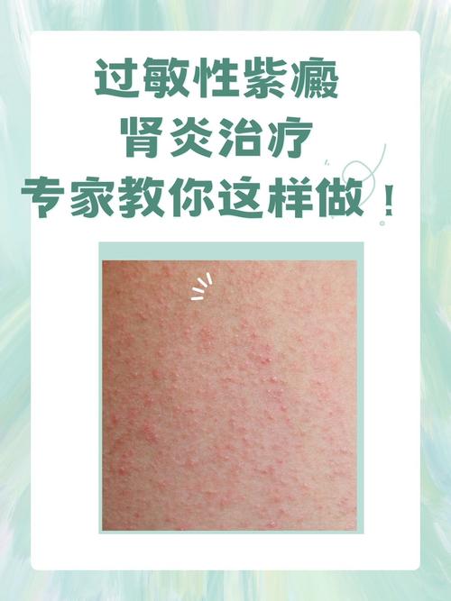 成人过敏性紫癜怎么治疗？快速有效的方法