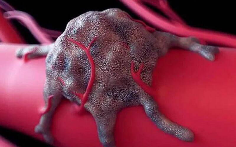 尤文氏肉瘤是绝症吗？能治愈吗？最新治疗方法及预后分析