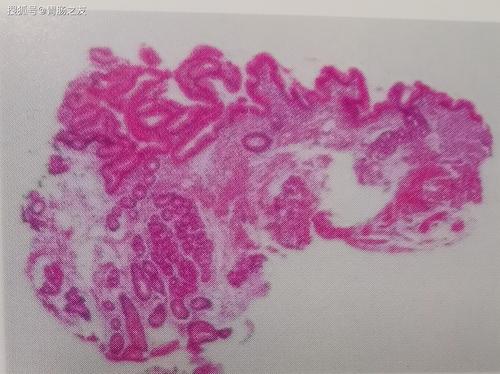 巴雷特食管真的能治愈吗?选择哪种治疗方法才能更好地控制病情?