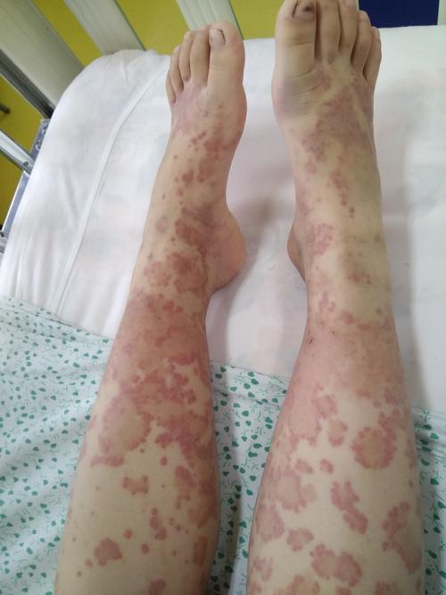 大人小孩过敏性紫癜能根治吗？不同情况的治疗方案？