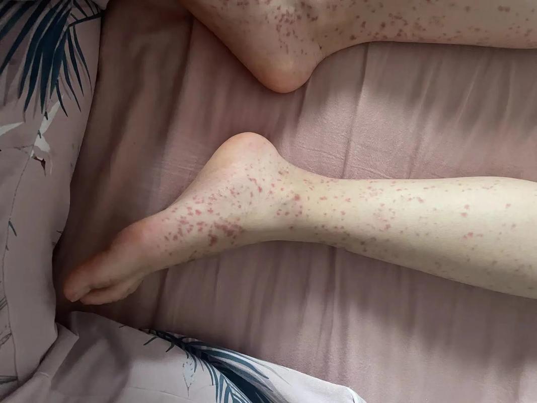 大人小孩过敏性紫癜能根治吗？不同情况的治疗方案？