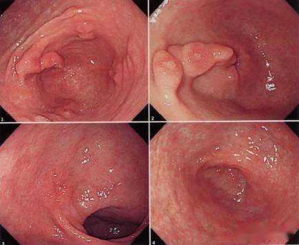 巴雷特食管真的能治愈吗?选择哪种治疗方法才能更好地控制病情?