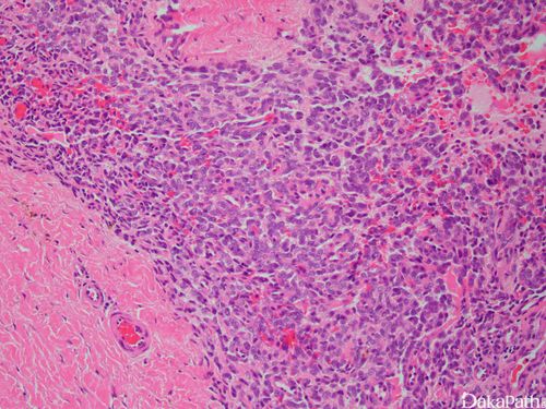 尤文氏肉瘤是绝症吗？能治愈吗？最新治疗方法及预后分析