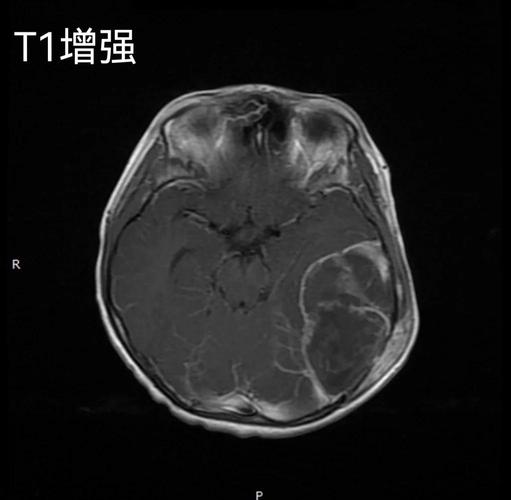 尤文氏肉瘤是绝症吗？能治愈吗？最新治疗方法及预后分析