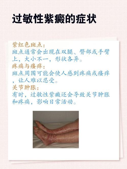 成人过敏性紫癜怎么治疗？快速有效的方法