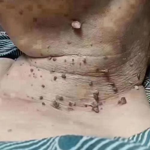 得了尤文氏肉瘤一定治不好吗？治疗希望有多大？