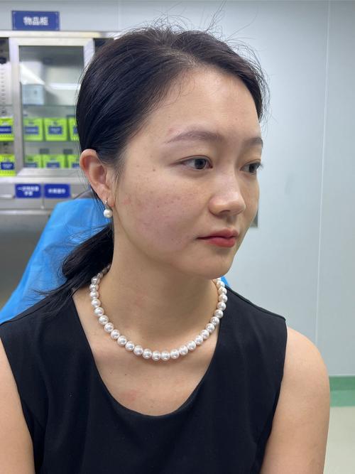 薇娅手术过程怎么样?完整揭露手术步骤及恢复秘诀!