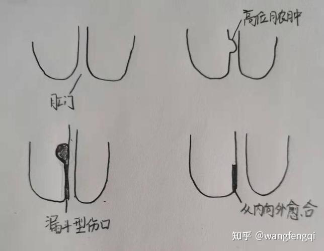 薇娅手术过程怎么样?完整揭露手术步骤及恢复秘诀!