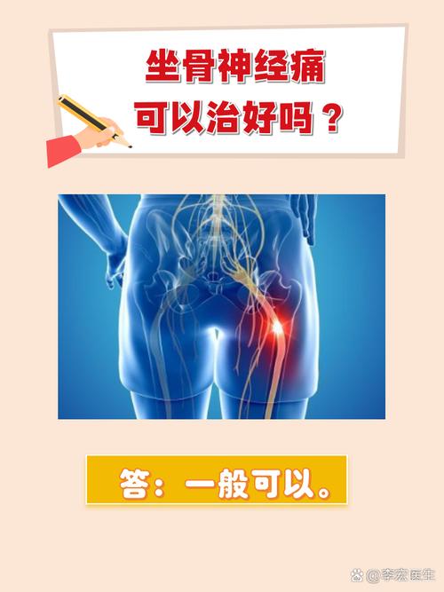 坐骨神经痛怎么治疗?医生推荐的缓解疼痛妙法!